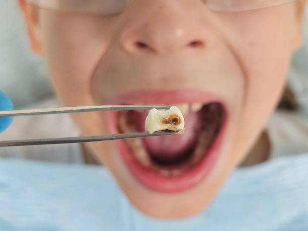 Best Emergency Treatment for Dental Infections or Abscesses in Pleasureville, PA